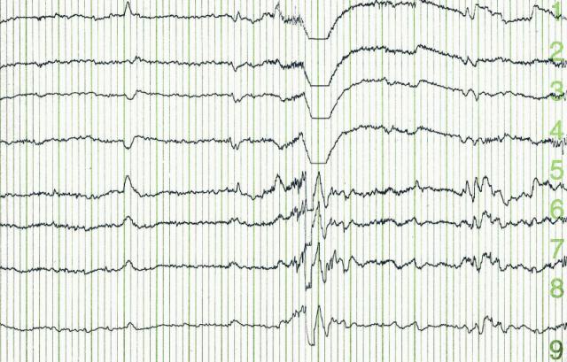 EEG brain wave printout
