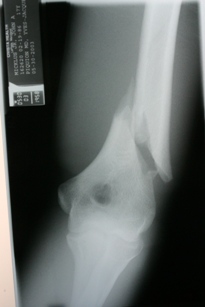 X ray of pitching elbow