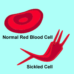Normal red blood cell and sickled cell
