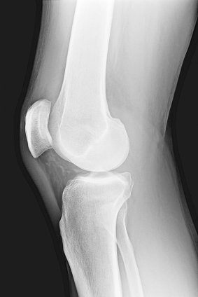 X-ray of knee including medial meniscus